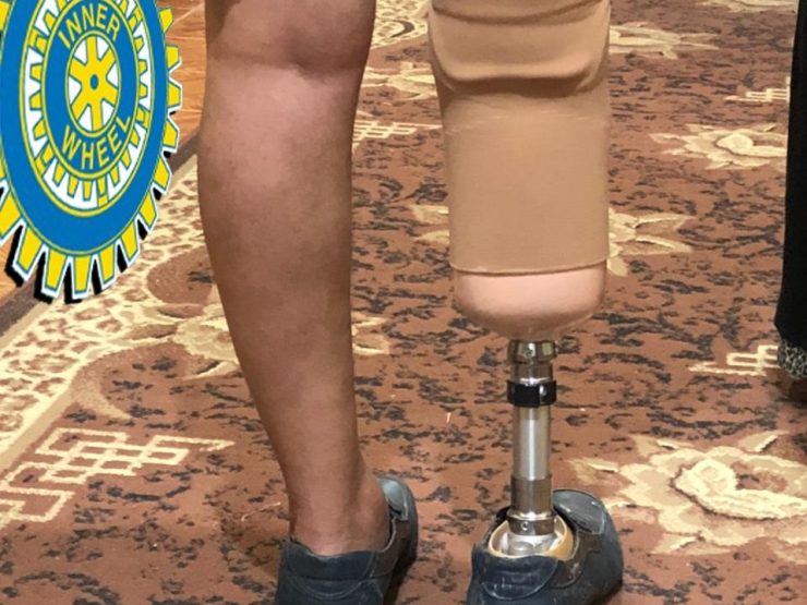 1-A prosthetic limb to an amputated leg