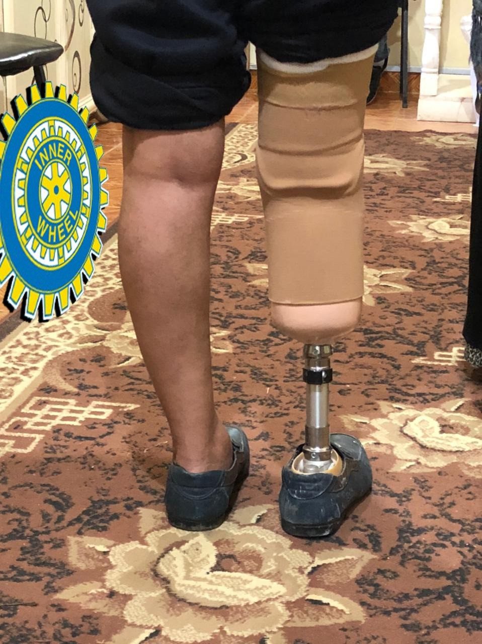 1-A prosthetic limb to an amputated leg