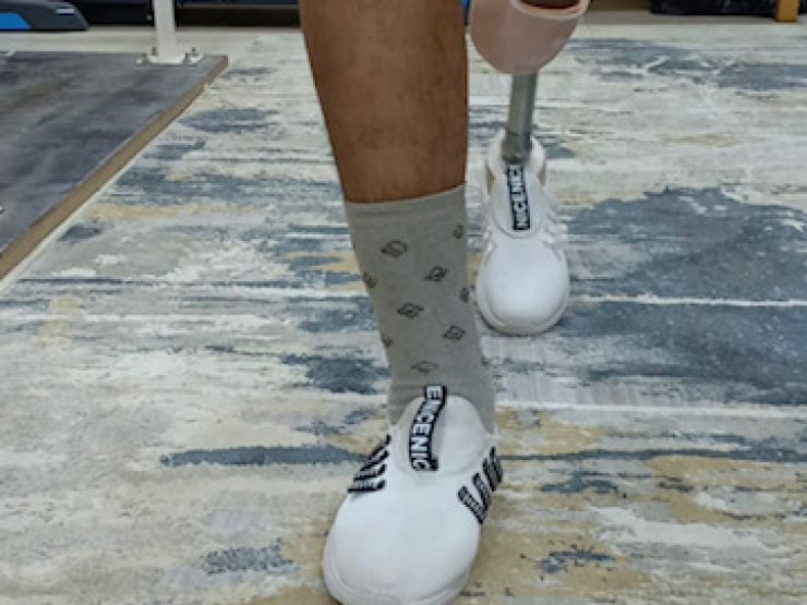 1-Artificial Limb to an amputated leg