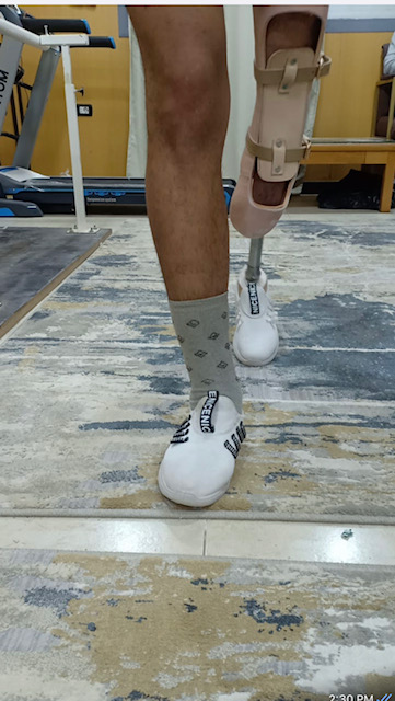 1-Artificial Limb to an amputated leg