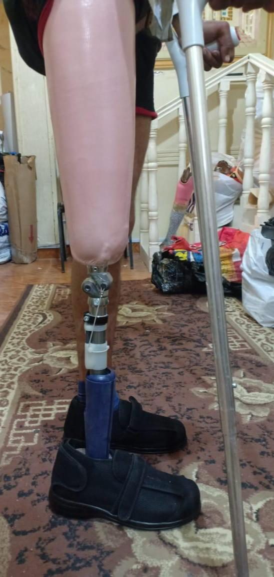 1-The donated Prosthetic limb